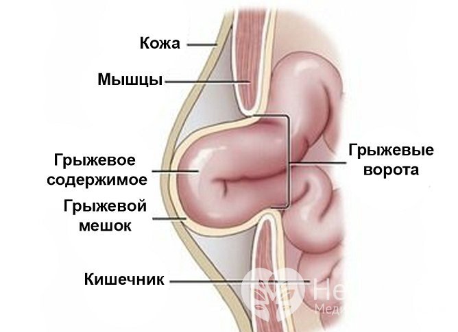 Вентральная грыжа образуется как одно из поздних послеоперационных осложнений