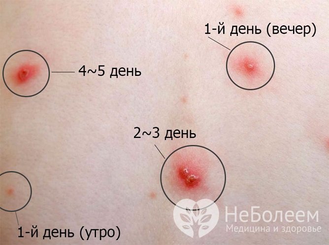 Высыпания развиваются в несколько этапов