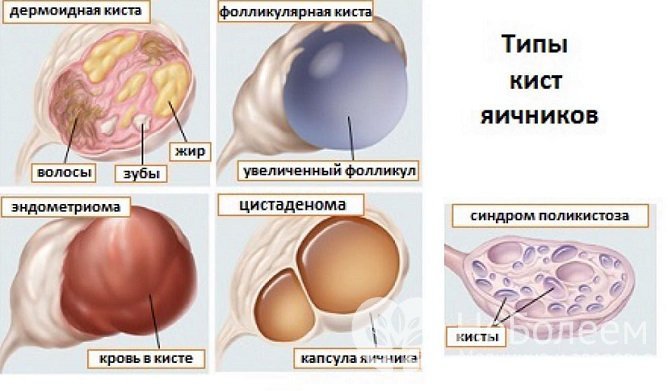 Кисты яичников отличаются происхождением, строением, размером и прогнозом