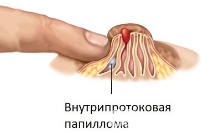 Внутрипротоковая папиллома молочной железы