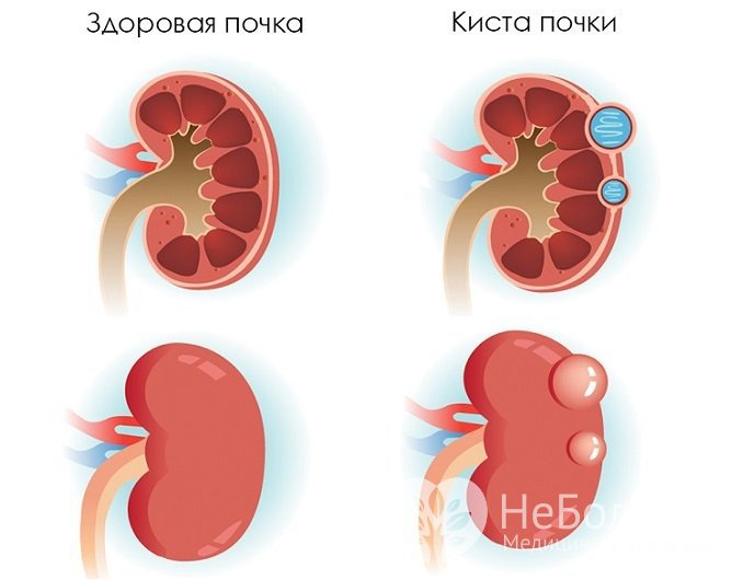 Киста почки - доброкачественное новообразование, способное, однако, перерождаться в раковую опухоль