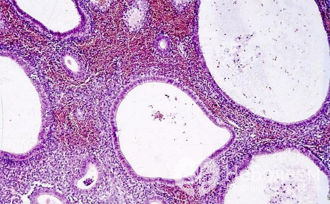 Железисто-фиброзные полипы состоят из железистых клеток и клеток соединительной ткани