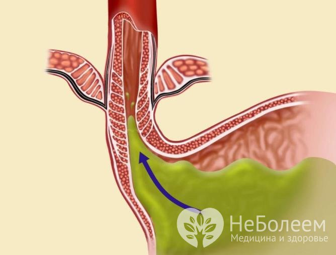Что такое ГЭРБ и почему он возникает